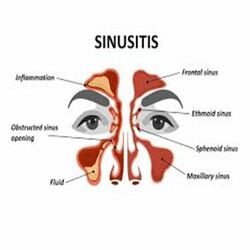 Sinus surgery in Bangalore