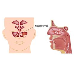 FESS surgery in Bangalore