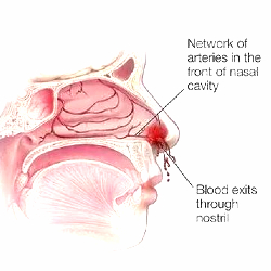epistaxis