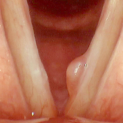 vocal polyp